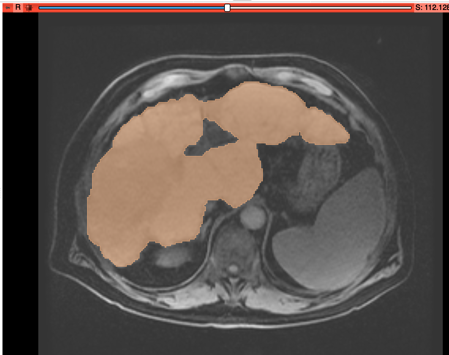 MeVisLab-exported segmentation overlaid in Slicer